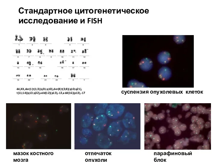 Стандартное цитогенетическое исследование и FISH 44,XX,der(1)t(1;3)(q31;q10),der(8)t(3;8)(q10;q21), t(11;14)(q13;q32),add(12)(p13),-13,add(16)(p13),-17 суспензия опухолевых клеток отпечаток опухоли парафиновый