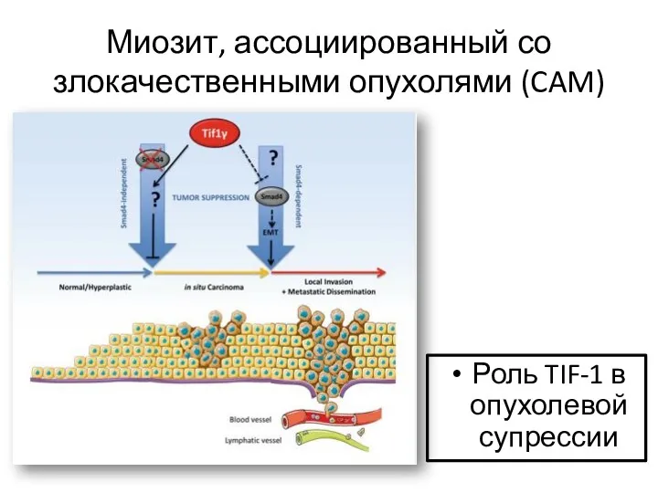 Миозит, ассоциированный со злокачественными опухолями (CAM) Роль TIF-1 в опухолевой супрессии