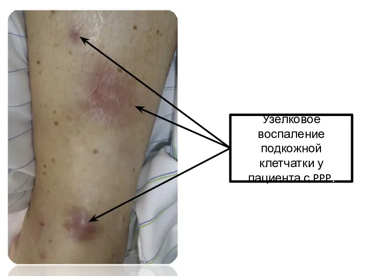 Узелковое воспаление подкожной клетчатки у пациента с PPP.