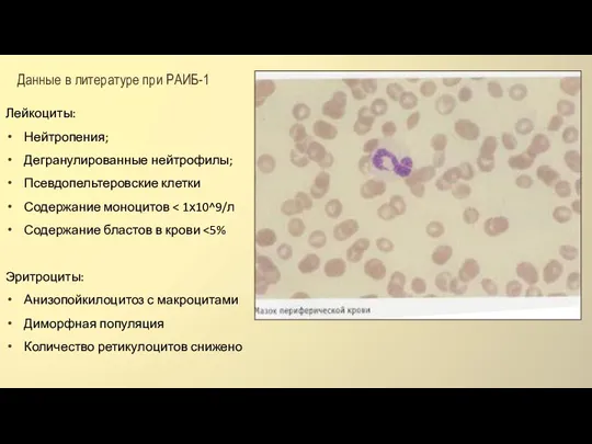 Данные в литературе при РАИБ-1 Лейкоциты: Нейтропения; Дегранулированные нейтрофилы; Псевдопельтеровские клетки Содержание моноцитов