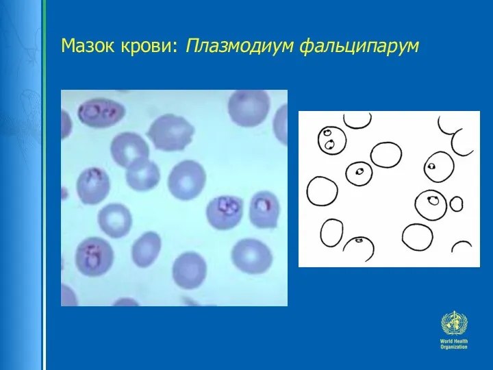 Мазок крови: Плазмодиум фальципарум