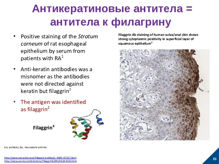 Антикератиновые антитела = антитела к филагрину Positive staining of the