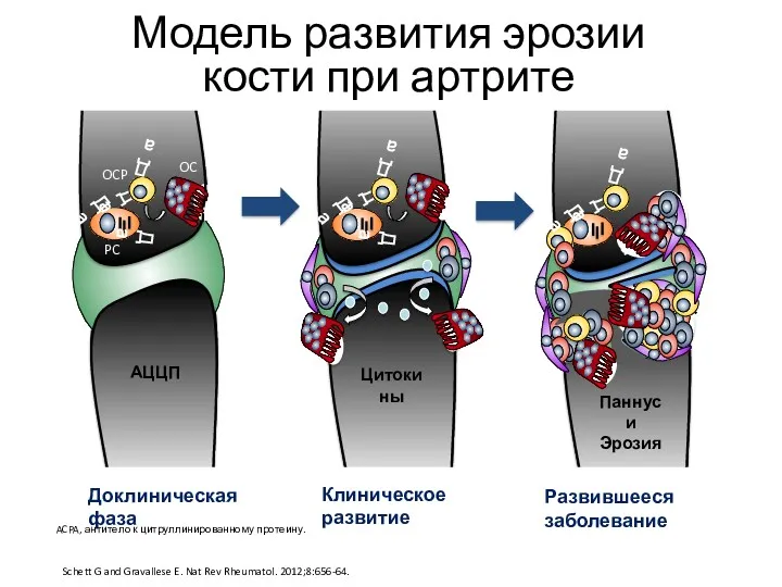 Да Да Да АЦЦП Да Паннус и Эрозия PC Да