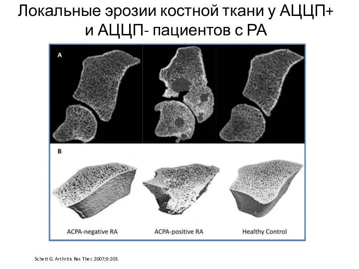 Локальные эрозии костной ткани у АЦЦП+ и АЦЦП- пациентов с