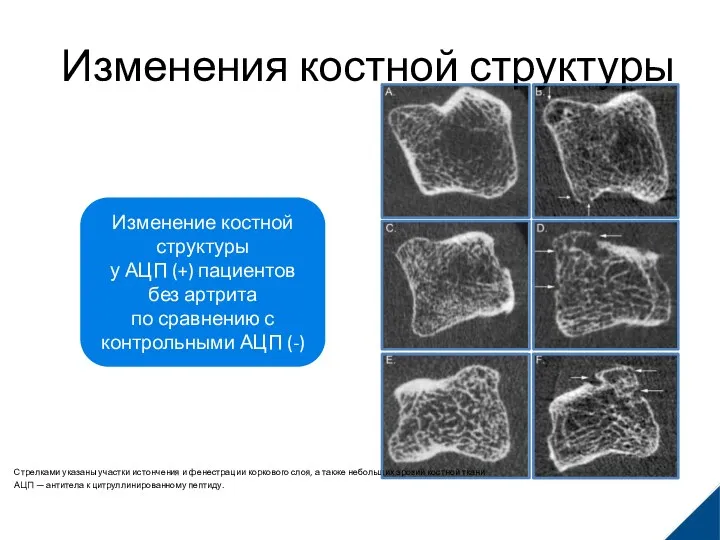 Изменения костной структуры Воспроизведено из: Kleyer A, et al. Ann