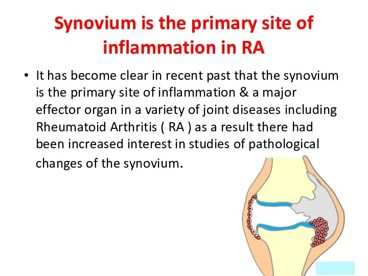 Synovium is the primary site of inflammation in RA It