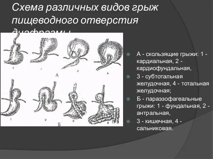 Схема различных видов грыж пищеводного отверстия диафрагмы. А - скользящие