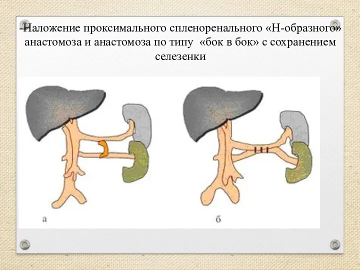 -Наложение проксимального спленоренального «Н-образного» анастомоза и анастомоза по типу «бок в бок» с сохранением селезенки