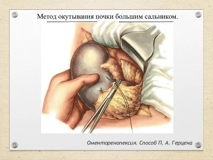 Метод окутывания почки большим сальником. Оменторенопексия. Способ П. А. Герцена