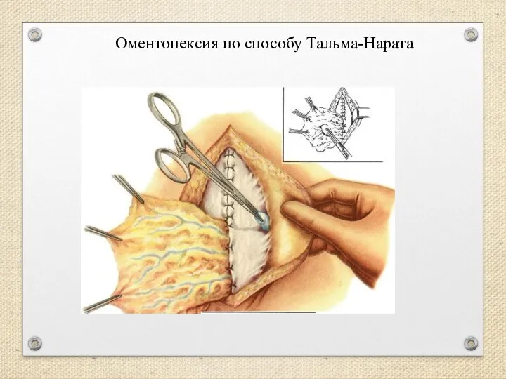 Оментопексия по способу Тальма-Нарата