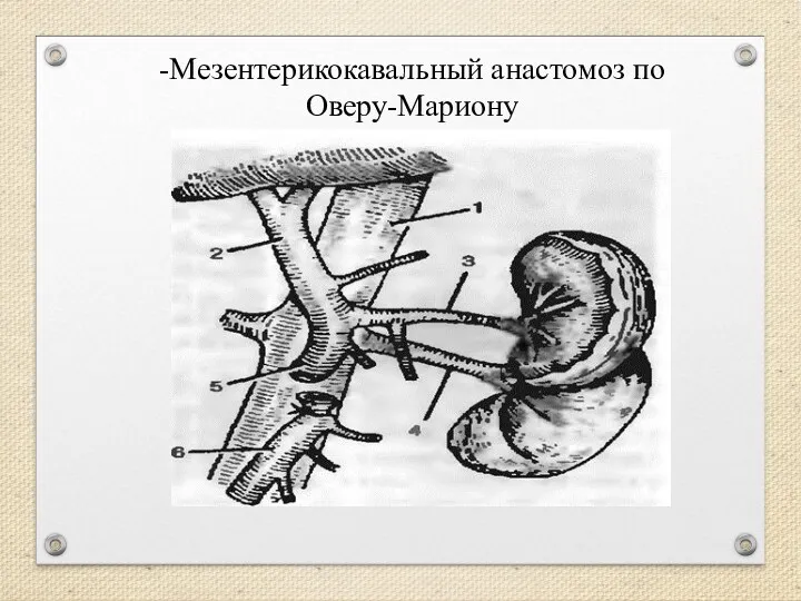 -Мезентерикокавальный анастомоз по Оверу-Мариону