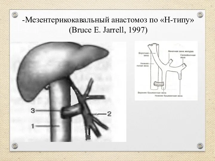 -Мезентерикокавальный анастомоз по «Н-типу» (Bruce E. Jarrell, 1997)