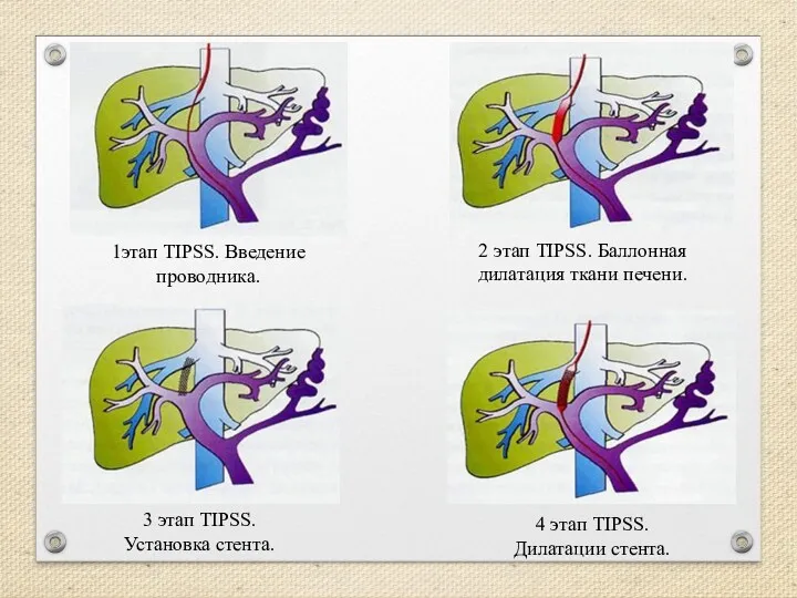 1этап TIPSS. Введение проводника. 2 этап TIPSS. Баллонная дилатация ткани