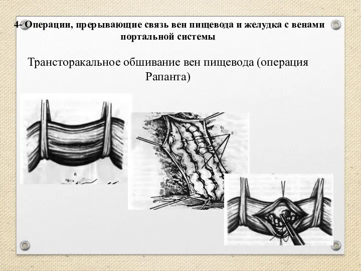 4- Операции, прерывающие связь вен пищевода и желудка с венами