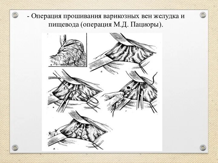 - Операция прошивания варикозных вен желудка и пищевода (операция М.Д. Пациоры).