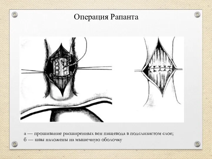 Операция Рапанта а — прошивание расширенных вен пищевода в подслизистом