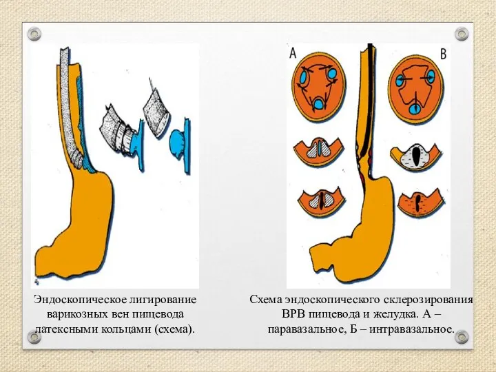 Эндоскопическое лигирование варикозных вен пищевода латексными кольцами (схема). Схема эндоскопического