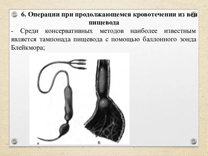 6. Операции при продолжающемся кровотечении из вен пищевода - Среди