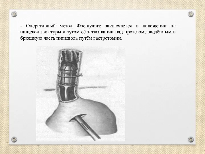 - Оперативный метод Фосшульте заключается в наложении на пищевод лигатуры