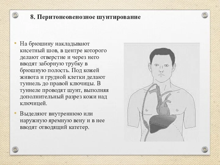 8. Перитонеовенозное шунтирование На брюшину накладывают кисетный шов, в центре