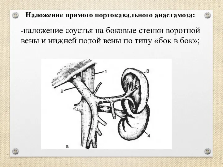 -наложение соустья на боковые стенки воротной вены и нижней полой