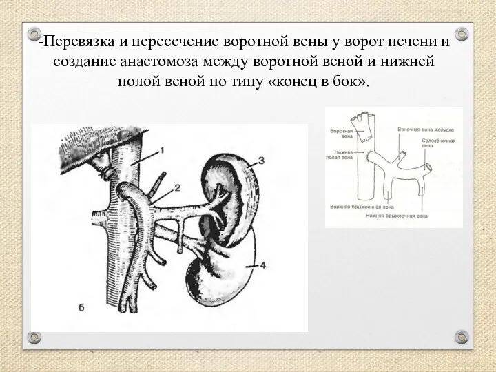 -Перевязка и пересечение воротной вены у ворот печени и создание