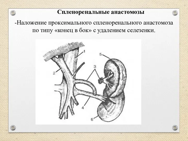 Спленоренальные анастомозы -Наложение проксимального спленоренального анастомоза по типу «конец в бок» с удалением селезенки.