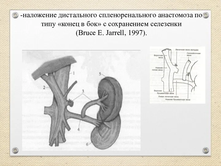 -наложение дистального спленоренального анастомоза по типу «конец в бок» с сохранением селезенки (Bruce E. Jarrell, 1997).