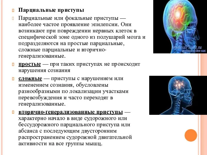 Парциальные приступы Парциальные или фокальные приступы — наиболее частое проявление