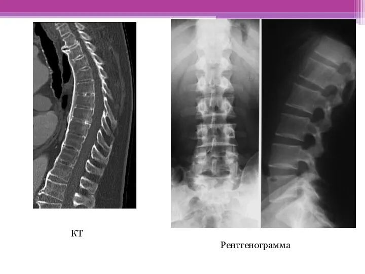 КТ Рентгенограмма