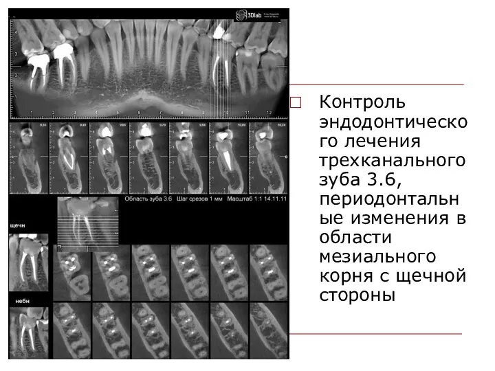 Контроль эндодонтического лечения трехканального зуба 3.6, периодонтальные изменения в области мезиального корня с щечной стороны