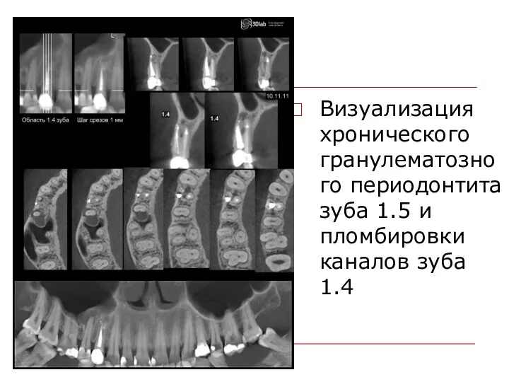 Визуализация хронического гранулематозного периодонтита зуба 1.5 и пломбировки каналов зуба 1.4