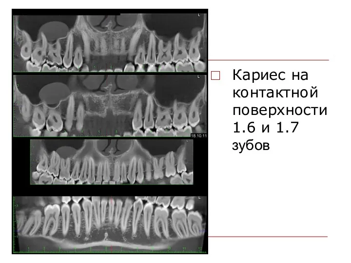 Кариес на контактной поверхности 1.6 и 1.7 зубов