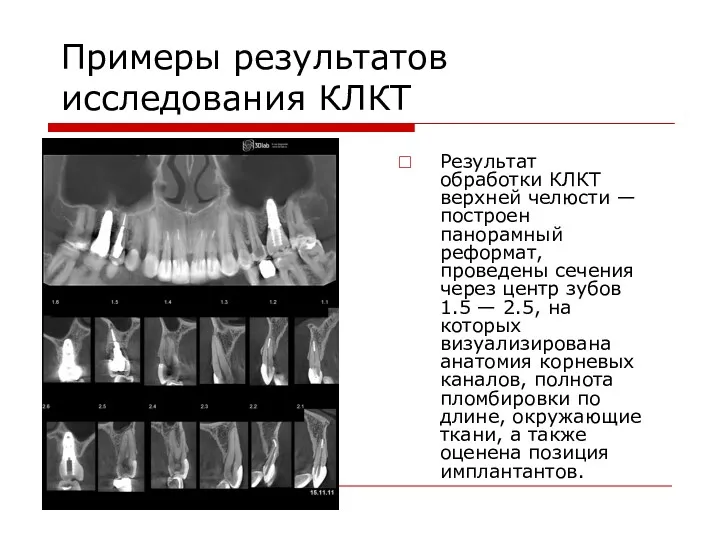 Примеры результатов исследования КЛКТ Результат обработки КЛКТ верхней челюсти — построен панорамный реформат,