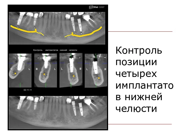 Контроль позиции четырех имплантатов нижней челюсти