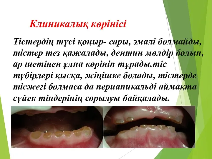 Клиникалық көрінісі Тістердің түсі қоңыр- сары, эмалі болмайды, тістер тез