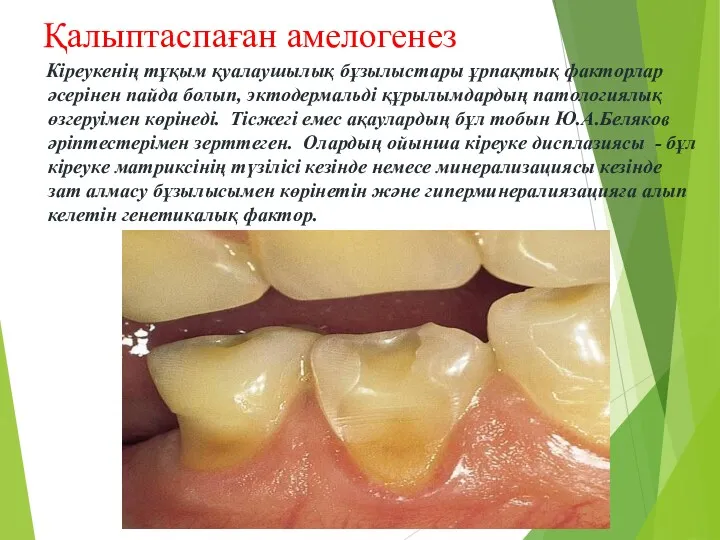 Қалыптаспаған амелогенез Кіреукенің тұқым қуалаушылық бұзылыстары ұрпақтық факторлар әсерінен пайда