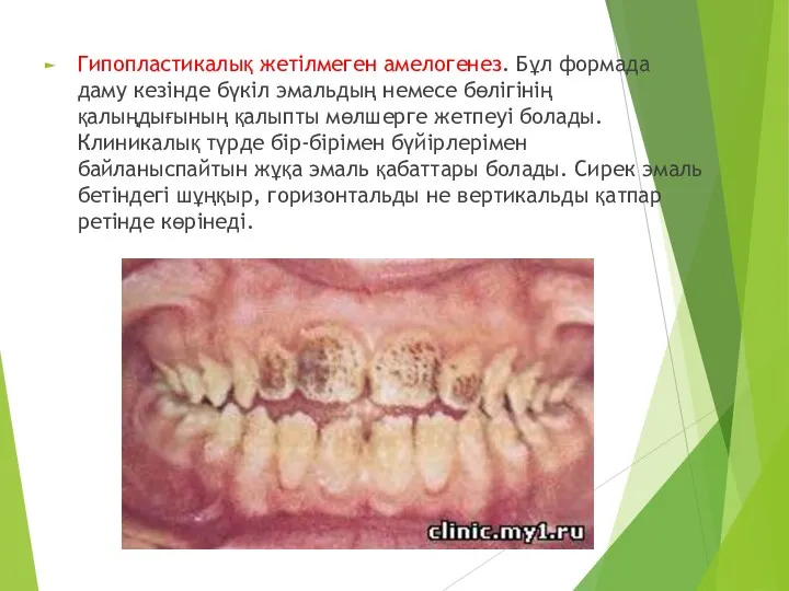 Гипопластикалық жетілмеген амелогенез. Бұл формада даму кезінде бүкіл эмальдың немесе