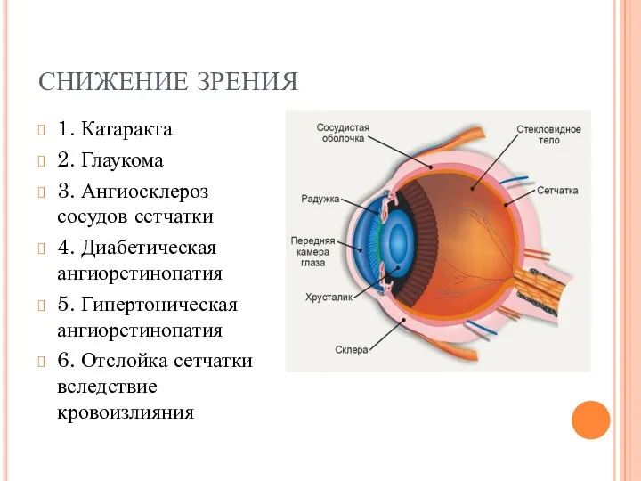 СНИЖЕНИЕ ЗРЕНИЯ 1. Катаракта 2. Глаукома 3. Ангиосклероз сосудов сетчатки