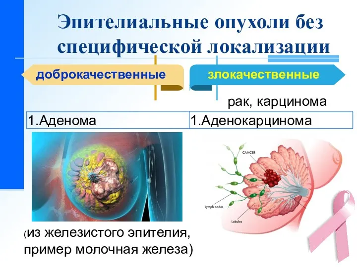 Эпителиальные опухоли без специфической локализации доброкачественные рак, карцинома (из железистого эпителия, пример молочная железа)