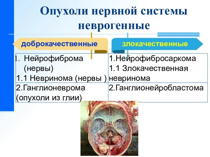 Опухоли нервной системы неврогенные доброкачественные