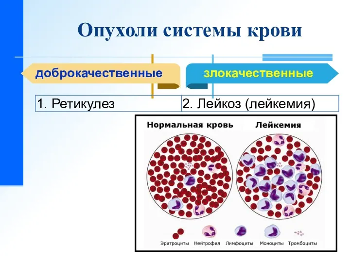 Опухоли системы крови доброкачественные