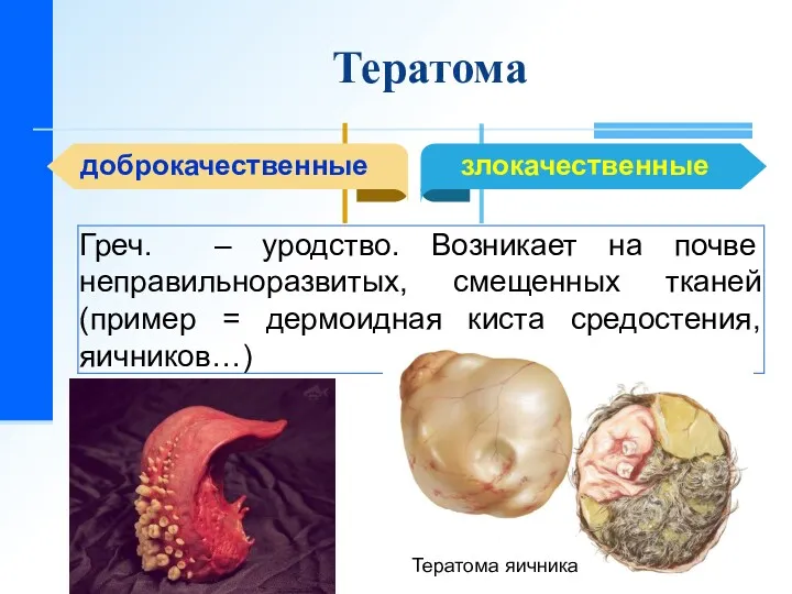 Тератома доброкачественные Тератома яичника