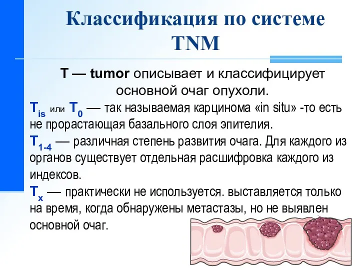 T — tumor описывает и классифицирует основной очаг опухоли. Tis