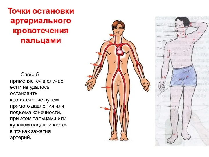 Точки остановки артериального кровотечения пальцами Способ применяется в случае, если