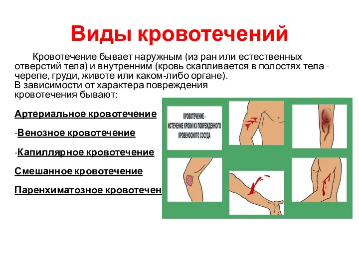 Виды кровотечений Кровотечение бывает наружным (из ран или естественных отверстий