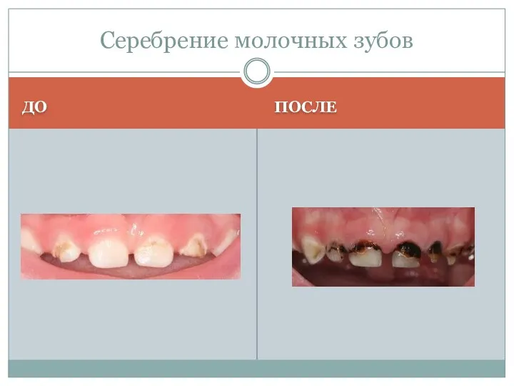 ДО ПОСЛЕ Серебрение молочных зубов