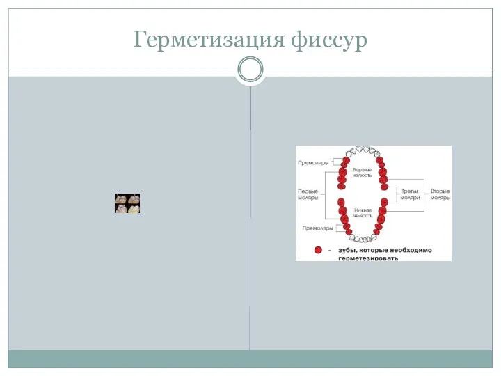 Герметизация фиссур