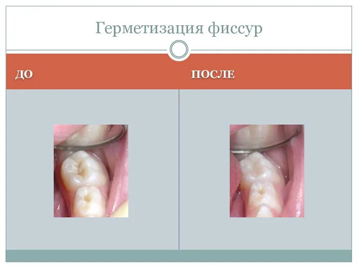 ДО ПОСЛЕ Герметизация фиссур