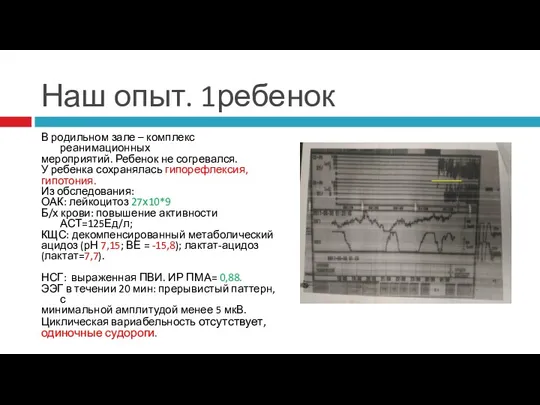 Наш опыт. 1ребенок В родильном зале – комплекс реанимационных мероприятий.